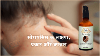 सोरायसिस के लक्षण, प्रकार और उपचार