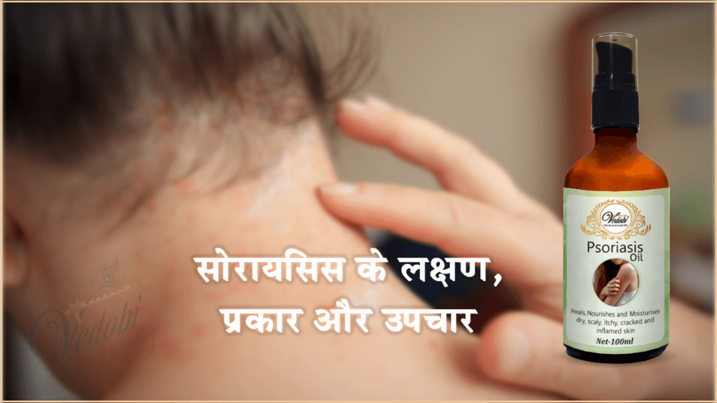 सोरायसिस के लक्षण, प्रकार और उपचार