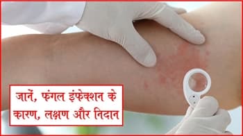 जानें, फंगल इंफेक्शन कारण, लक्षण और निदान