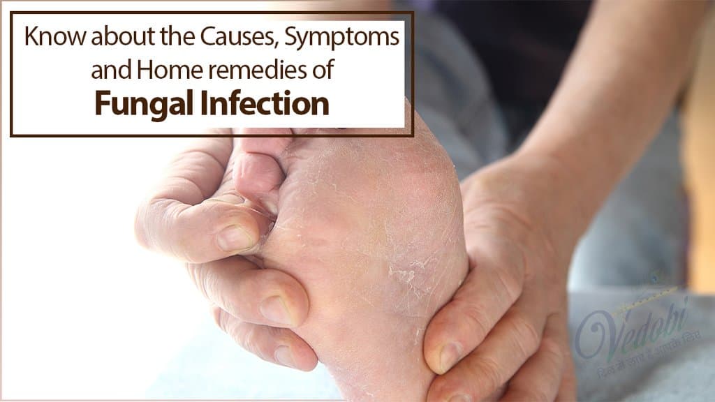 Learn about Fungal Infection, its Causes, Symptoms and Home remedies