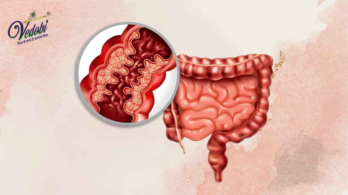 इंफ्लेमेंटरी बाउल डिजीज (IBD) के कारण, लक्षण और घरेलू उपचार