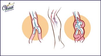 वैरिकोज नसें (veins) क्या है? जानें, इसके कारण, लक्षण और घरेलू उपाय