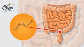 What are Intestinal Worms? Know its Causes, Symptoms and Home remedies