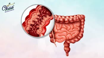 इंफ्लेमेंटरी बाउल डिजीज (IBD) के कारण, लक्षण और घरेलू उपचार