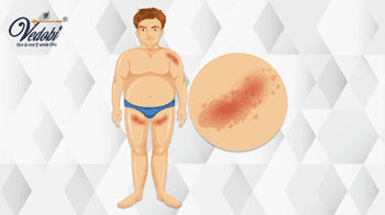 What is Chancroid? Know its Causes and Symptoms