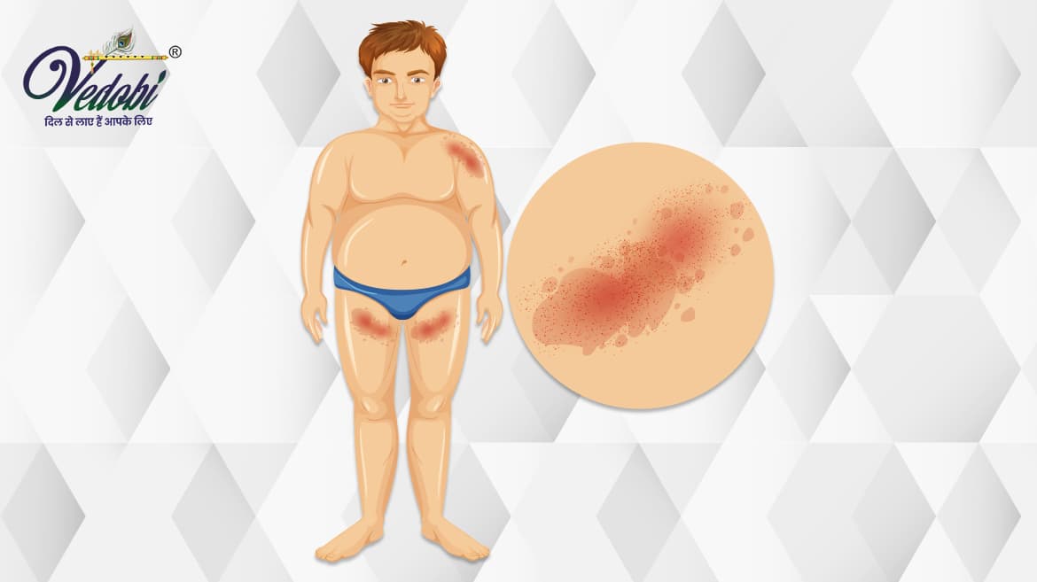 What is Chancroid? Know its Causes and Symptoms