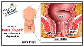 क्या होता है एनल फिशर? जानें, इसके कारण और घरेलू उपचारों को