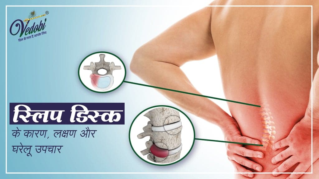 स्लिप डिस्क के कारण, लक्षण और घरेलू उपचार