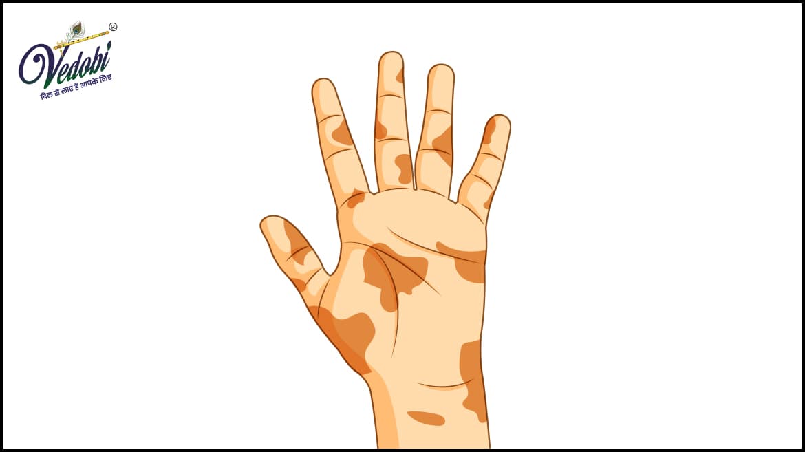 Know the Causes, Symptoms and Diagnosis of Leprosy