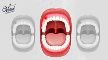 Types, Causes, Symptoms and Treatment methods of Herpes