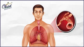 What is Achalasia? Know its Symptoms, Causes and Home remedies