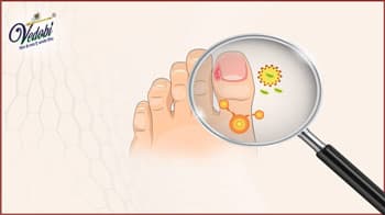 What causes Jock Itch? Know about its Symptoms & Treatment